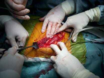 &Auml;rzte entnehmen eine Niere (Symbolbild). Bei Herztransplantationen an der Uniklinik Heidelberg ist es zu Unregelm&auml;&szlig;igkeiten gekommen.