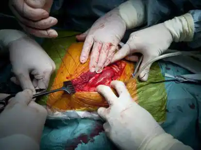 &Auml;rzte entnehmen eine Niere (Symbolbild). Bei Herztransplantationen an der Uniklinik Heidelberg ist es zu Unregelm&auml;&szlig;igkeiten gekommen.