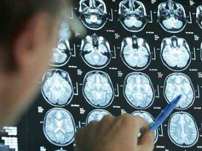 Ob ein Schlaganfall vorliegt, l&auml;sst sich mit bildgebenden Verfahren des Gehirns kl&auml;ren. Foto: Friso Gentsch/dpa