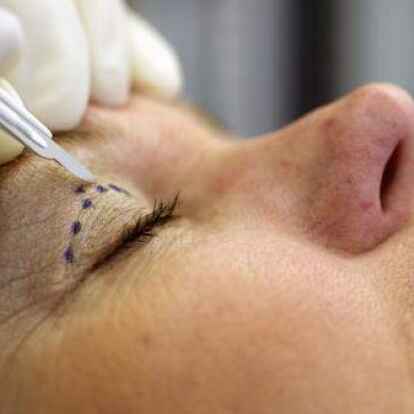 Korrekturen am  Augenlid: Viele Patienten w&uuml;nschen sich einen wacheren Blick.