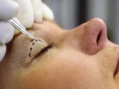 Korrekturen am  Augenlid: Viele Patienten w&uuml;nschen sich einen wacheren Blick.