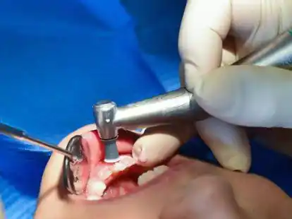 Ein kleines M&auml;dchen wird von einer Zahn&auml;rztin behandelt. Die &bdquo;Deckelung&ldquo; der Verg&uuml;tungen f&uuml;r Narkosen beim Kinderzahnarzt st&ouml;&szlig;t bei den Betroffenen auf Kritik.