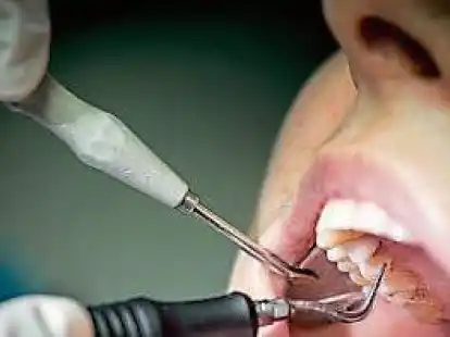 Wer regelm&auml;&szlig;ig zur Vorsorge geht und seine Z&auml;hne professionell reinigen l&auml;sst, kann Parodontitis vorbeugen. Besonders wichtig ist das f&uuml;r Diabetiker.