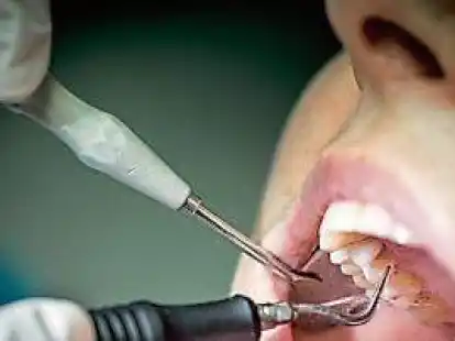 Die Kosten f&uuml;r eine Zahnreinigung muss man meist nicht alleine tragen. Wer sich den Zuschuss holen m&ouml;chte, sollte aber pr&uuml;fen, ob die Krankenkasse mit Selektivvertr&auml;gen arbeitet.