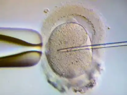 Bei einer Intrazytoplasmatische Spermieninjektion (ICSI) wird einer Eizelle ein Spermium injiziert.