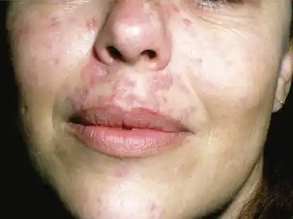 Ein Haut-Lupus breitet sich vor allem im Bereich der Nase und auf den Wangen des Betroffenen aus.