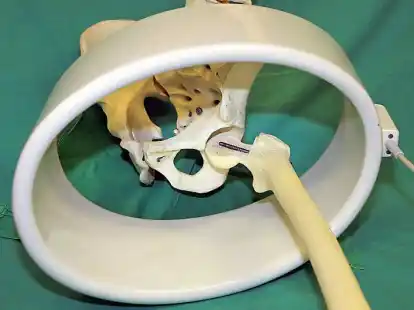 F&uuml;r den Austausch einer H&uuml;ftprothese stehen zahlreiche unterschiedliche Modelle zur Verf&uuml;gung.