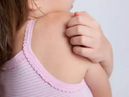 Welches&nbsp;Insekt zugestochen hat, kann man in der Regel nicht erkennen - es sei denn, ein Bienenstachel ist in der Haut stecken geblieben.