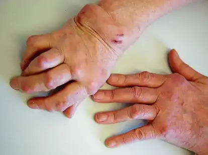 Eine fortgeschrittene Rheumatoide Arthritis mit starken Schwellungen und Ver&auml;nderungen ist gut erkennbar.