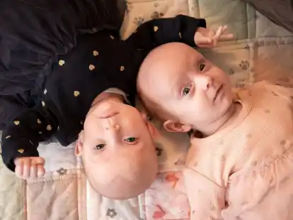 Einst am Bauch verbundene Zwillinge liegen nach der erfolgreichen Trennung Kopf an Kopf nebeneinander.