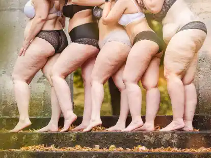 Frauen mit Lip&ouml;dem-Erkrankung. Betroffene k&auml;mpfen f&uuml;r eine Ent-Stigmatisierung der Krankheit und fordern mehr kompetente &Auml;rzte.