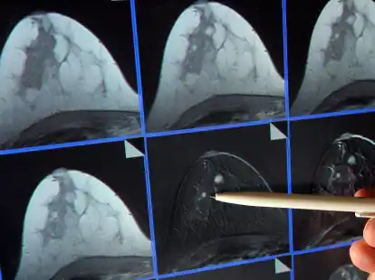 Symbolbild: Im Kreis Cloppenburg f&auml;llt die Diagnose Brustkrebs seltener aus als in anderen Landkreisen.