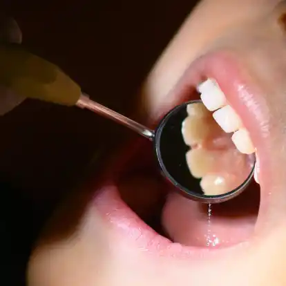 Fluoridlack soll die Zähne vor Karies schützen. Seit dem 24. April 2024 haben nun alle Kinder unter sechs Jahren unabhängig vom Kariesrisiko einen Anspruch auf diese Leistung.