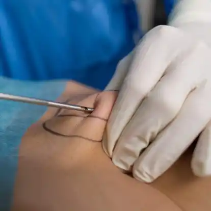 Unter bestimmten Voraussetzungen trägt die gesetzliche Krankenversicherung künftig die Kosten für eine Liposuktion.